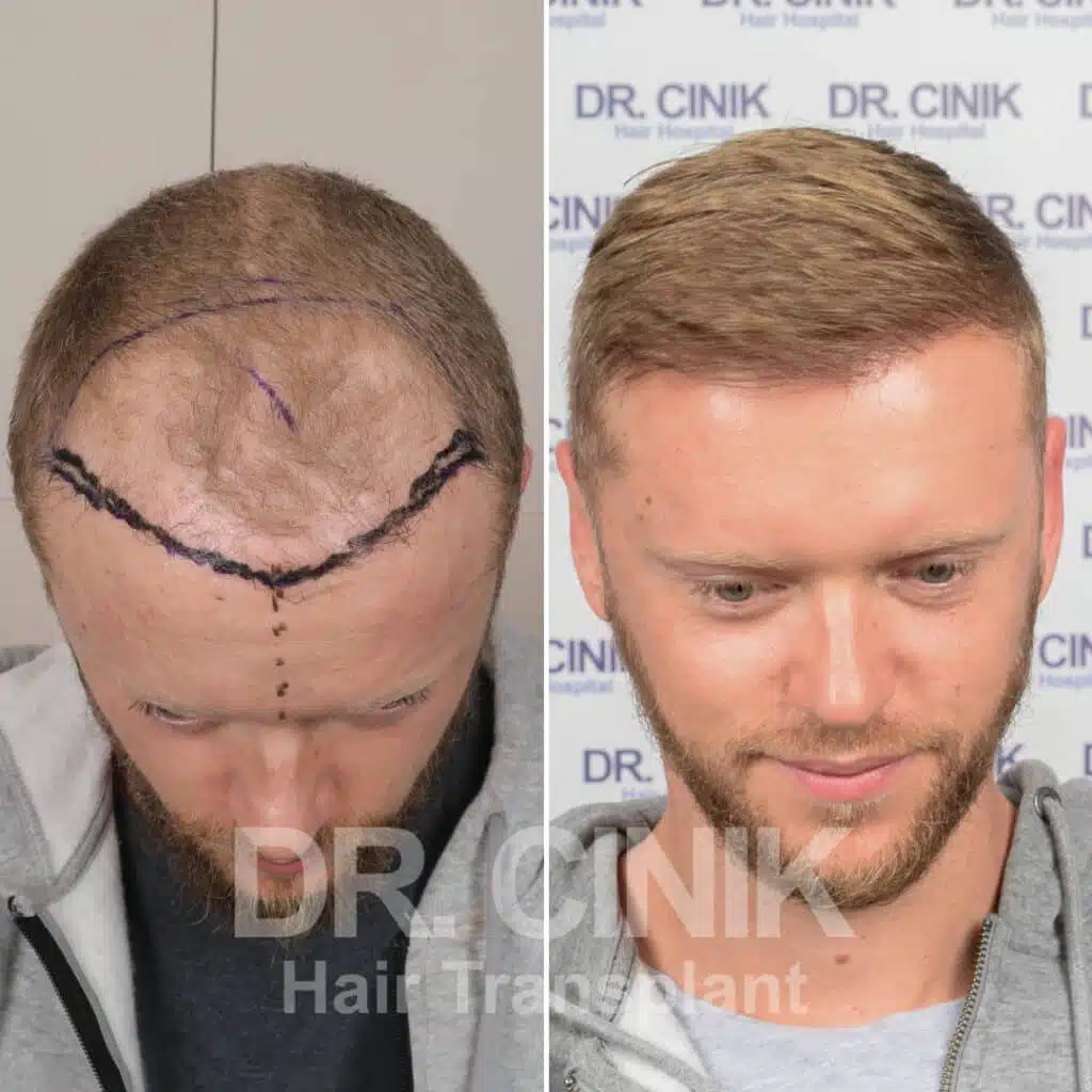 Greffe de cheveux FUE avant-après : 3700 greffons