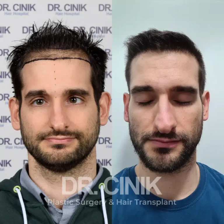 Greffe de cheveux FUE Saphir avant-après : 3400 greffons