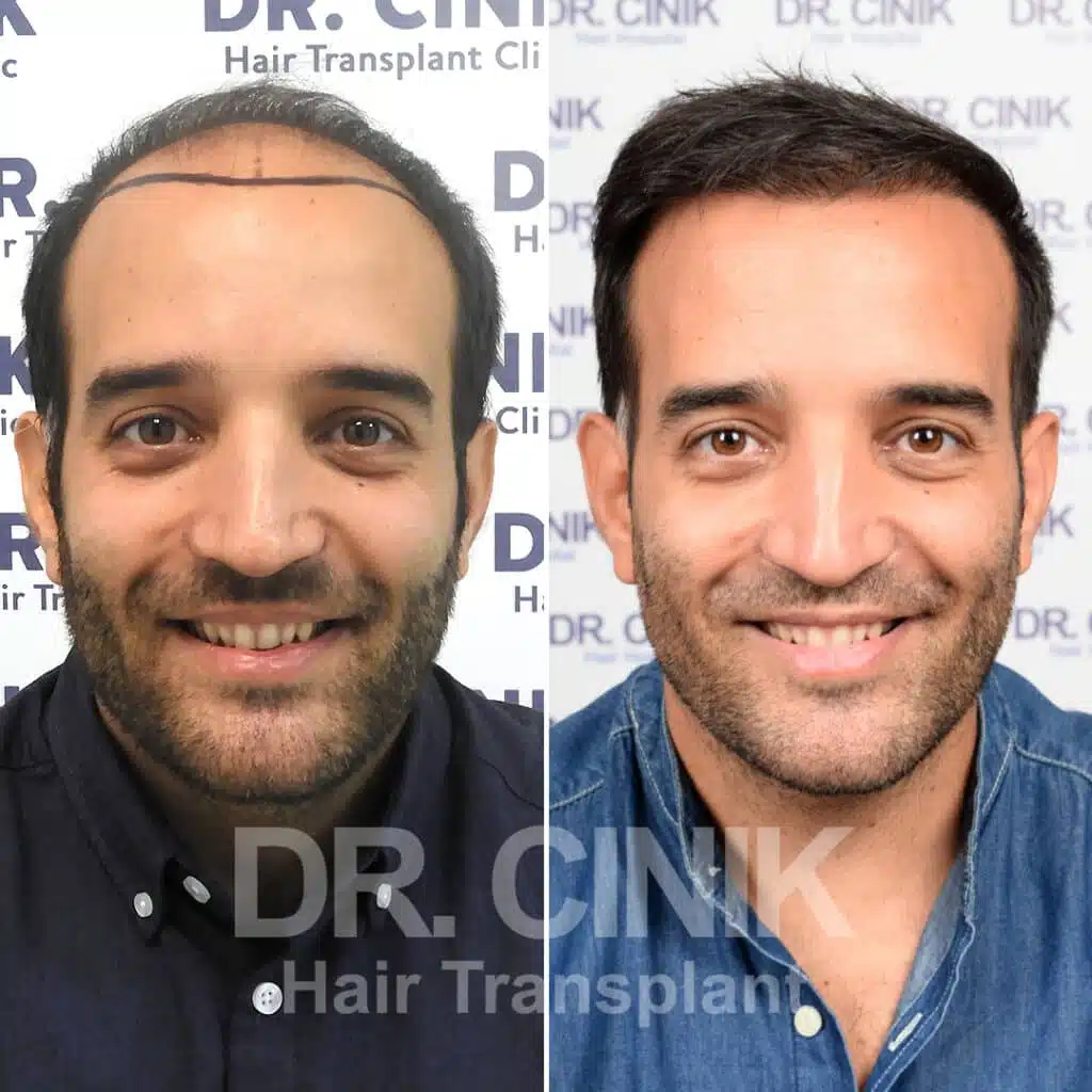 Greffe de cheveux FUE avant-après : 3400 greffons