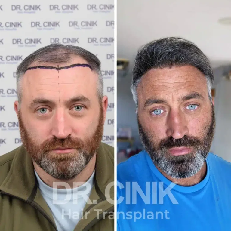 Greffe de cheveux DHI avant-après : 4450 greffons