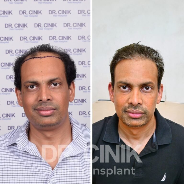 Greffe de cheveux DHI avant-après : 4100 greffons