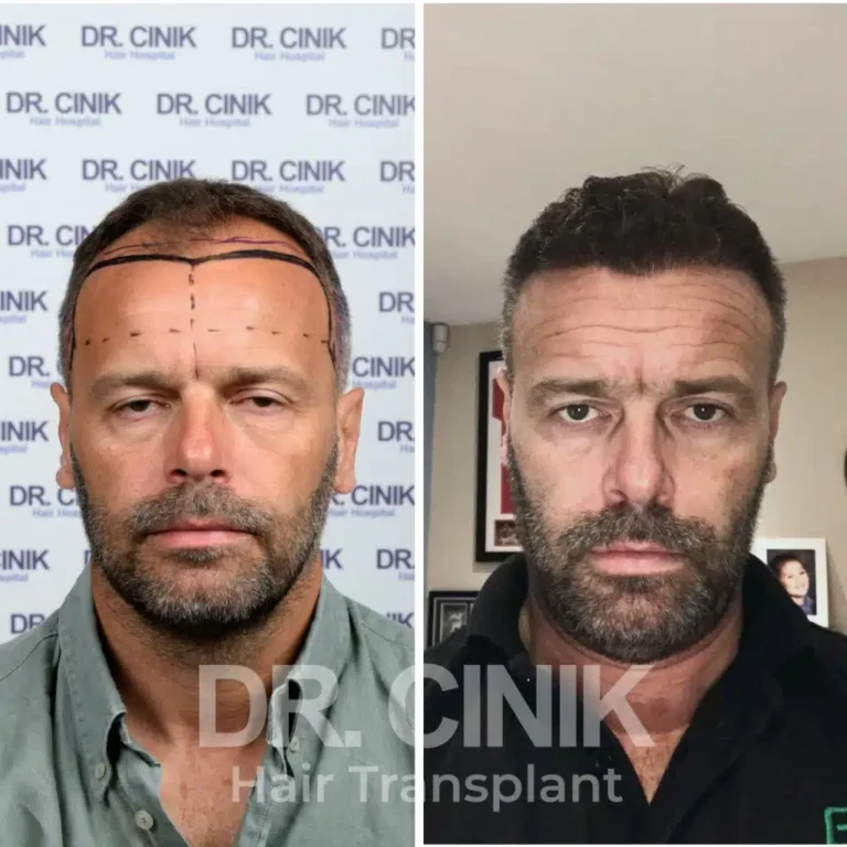 Greffe de cheveux DHI avant-après : 4250 greffons