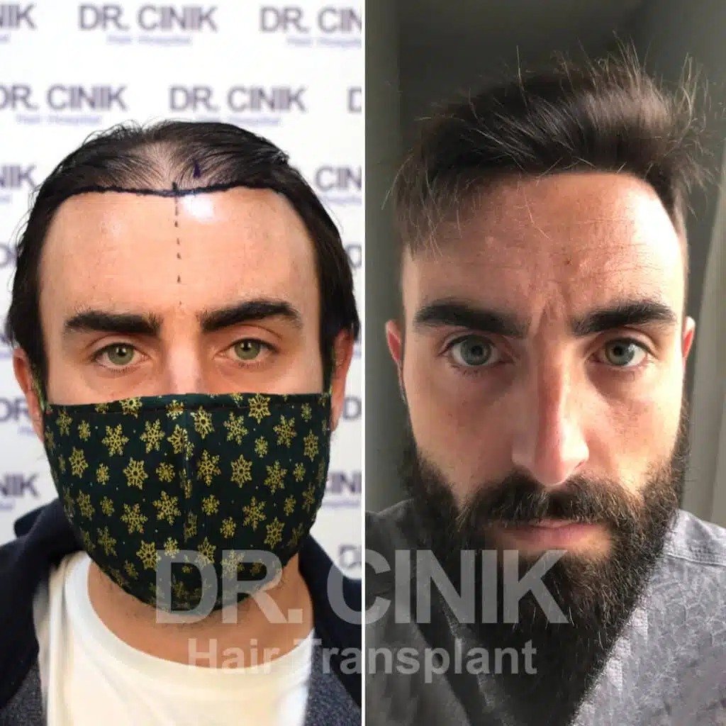 Greffe de cheveux FUE avant-après : 4232 greffons